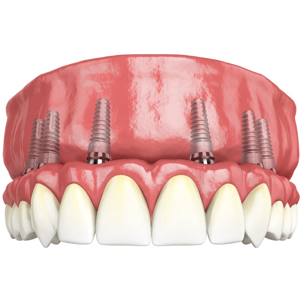 Completely Edentulous Patients With İmplant Supported Fixed