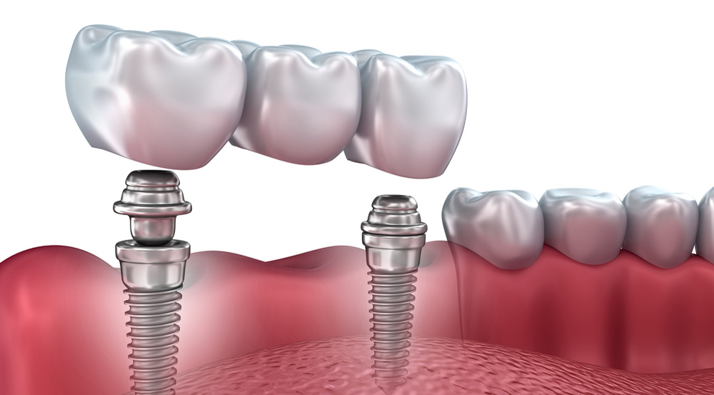 Dental Implant Supported Bridge