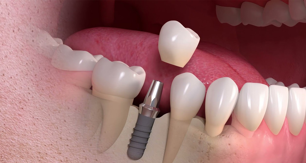 Best Dental Implants In Ankara