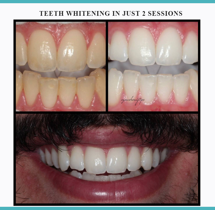 Teeth whitening in just 2 sessions