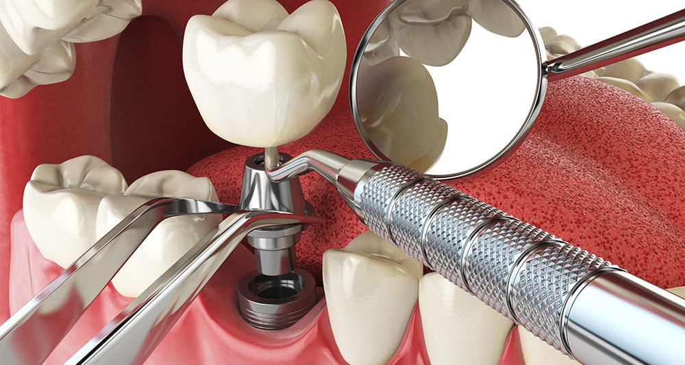 Longevity of Dental Implants