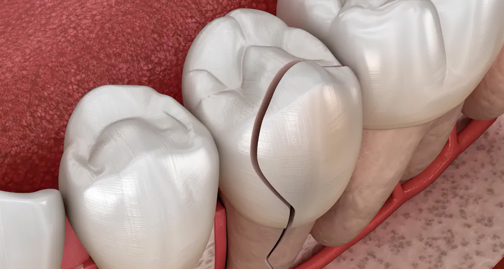 Repair Cracked Teeth In Ankara