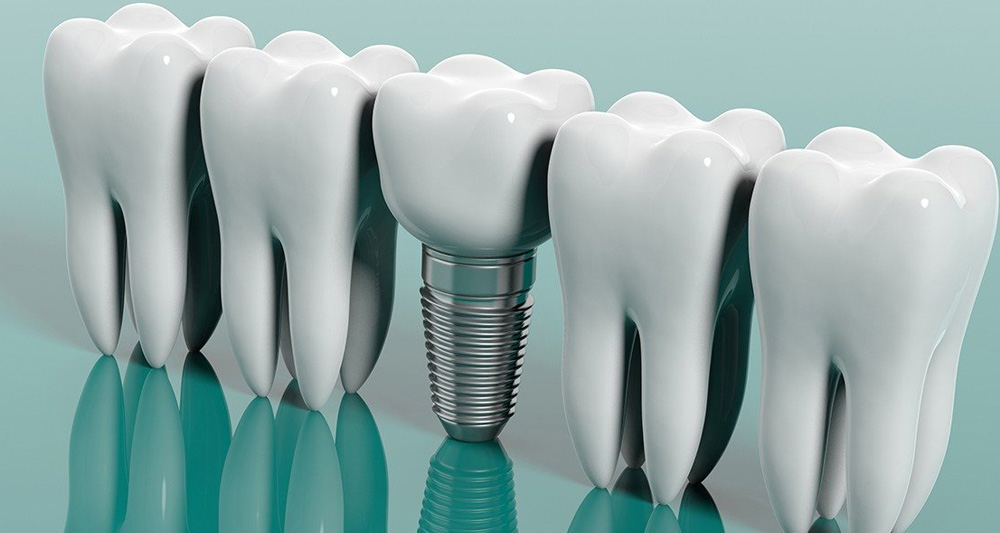 Three Reasons to Consider Dental Implants In Ankara