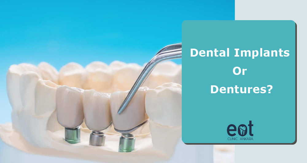 Dental Implants Or Dentures?