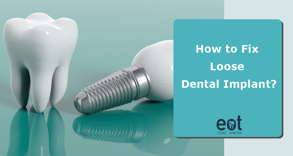 How to Fix Loose Dental Implant?