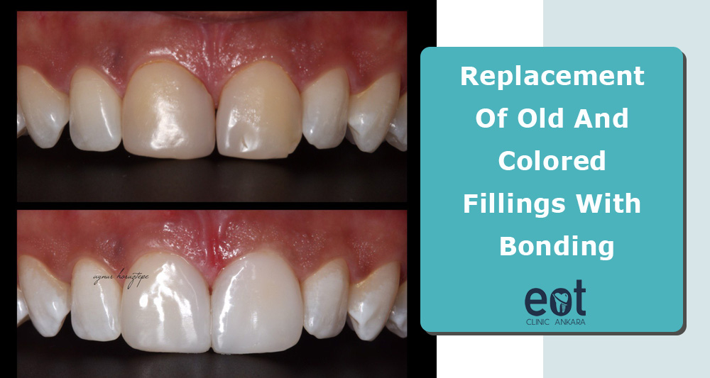 Old And Colored Fillings With Bonding