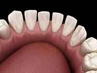 Gaps Between Teeth